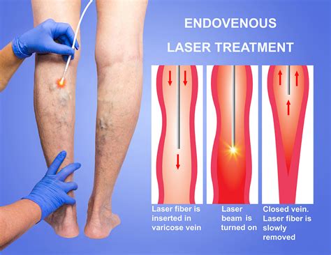 vene varicoase laser la nivelul picioarelor